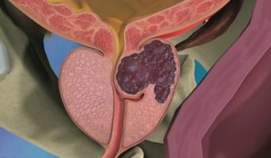 Prostata Ne İyi Gelir?