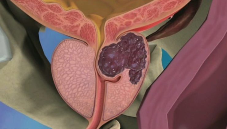 Prostata Ne İyi Gelir?