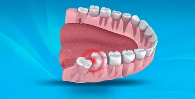 20’lik Diş Ağrısına Ne İyi Gelir?