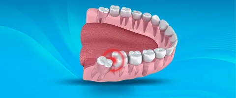 20’lik Diş Ağrısına Ne İyi Gelir?