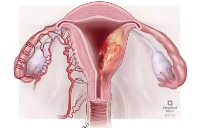 Endometrium Kanseri: Risk Faktörleri, Tanı ve Tedavi Yöntemleri